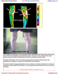Rheumatoid Arthritis Can Be Seen