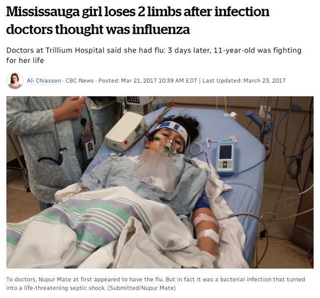 Mississauga girl loses 2 limbs after infection  doctors thought was influenza