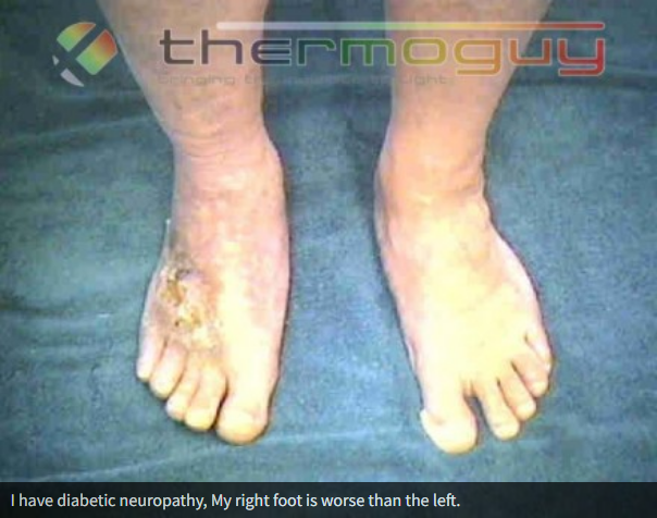 I have diabetic neuropathy; My right foot is worse than the left.