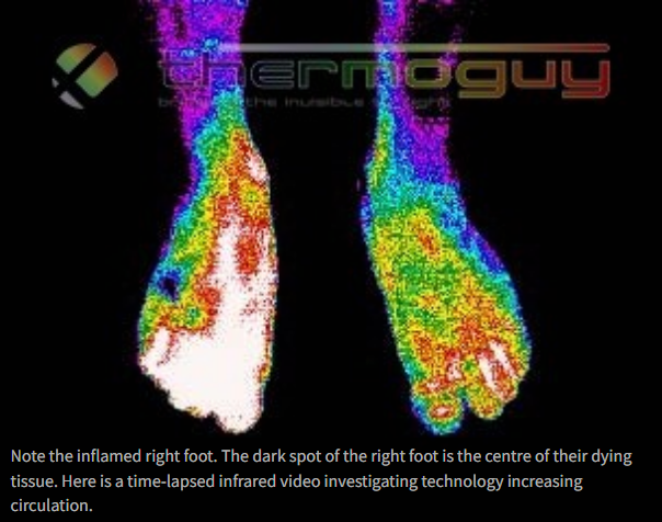 Note the inflamed right foot. The dark spot of the right foot is the centre of their dying tissue.
