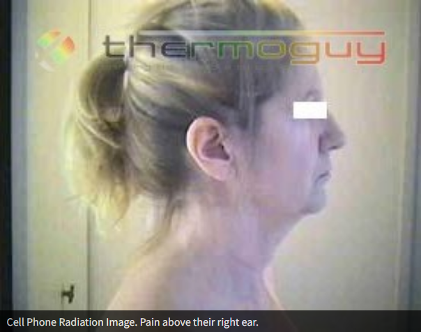 Cell Phone Radiation Image.Pain above their right ear.