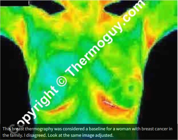 This breast thermography was considered a baseline for a woman with breast cancer in the family. I disagreed. Look at the same image adjusted.