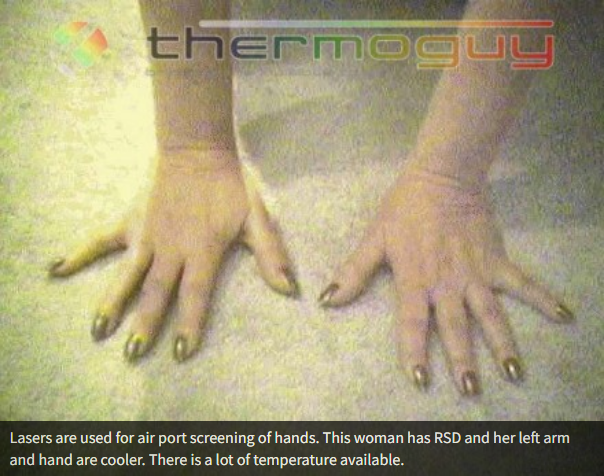 Lasers are used for airport screening of hands. This woman has RSD and her left arm and hand are cooler. There is a lot of temperature available.